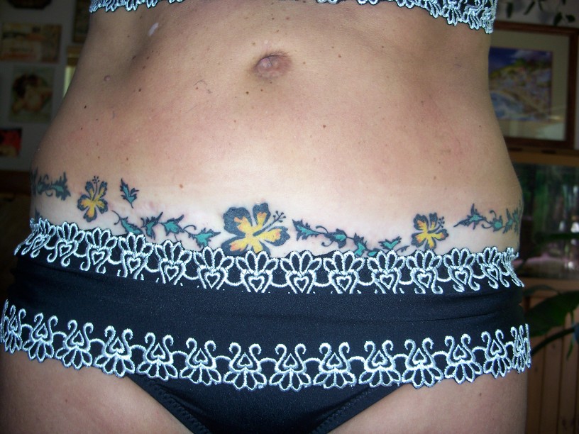 tummy tuck scars. tattoo over tummy tuck scar