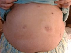 Belly shot - day of surgery. 3/24/09