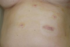 More information about "Here is a picture of my stomach the day after surgery"