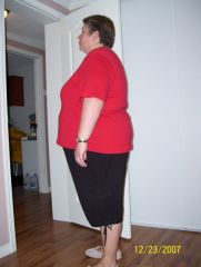 More information about "Pre-op 317 pounds side View"