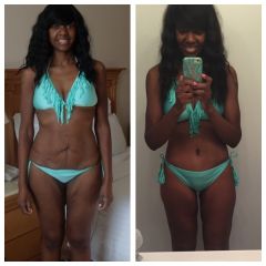 Before and after lower body lift 2015